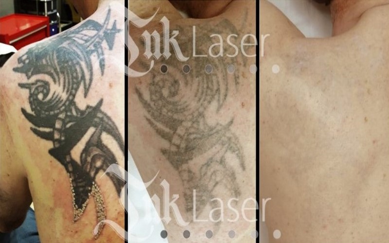quitar tatuajes laser