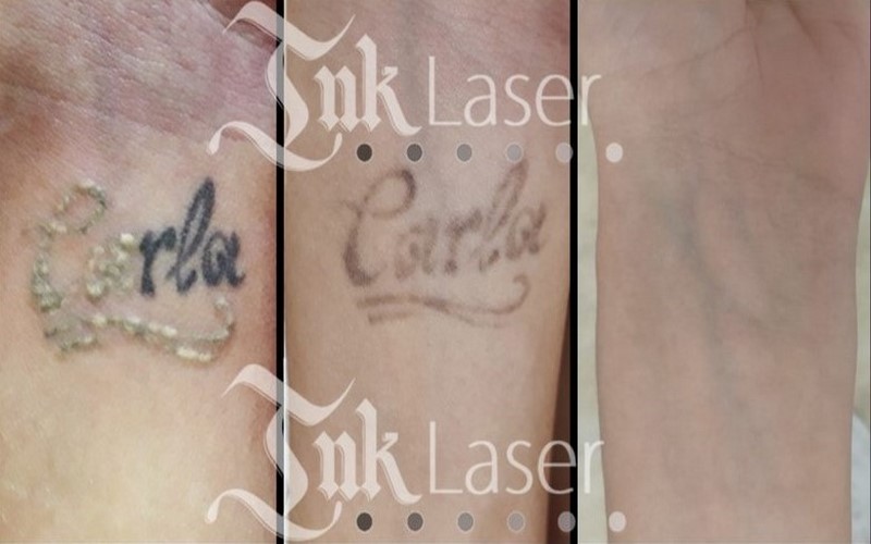 antes y despues tras eliminar tatuaje