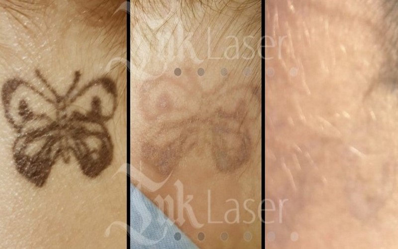 mejor laser para borrar tatuaje