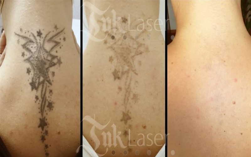 ventajas de borrar tatuaje con laser