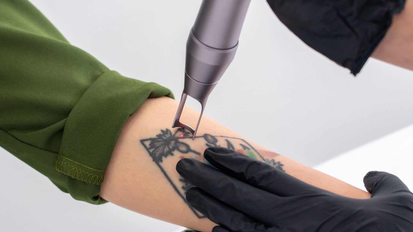 clinica para borrar tatuajes